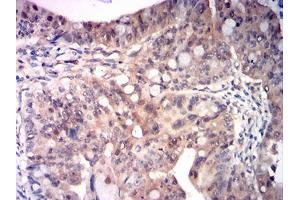 Immunohistochemical analysis of paraffin-embedded rectum cancer tissues using RRM1 mouse mAb with DAB staining. (RRM1 antibody  (AA 541-792))