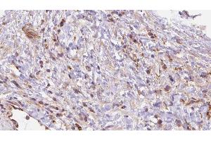ABIN6272698 at 1/100 staining Human liver cancer tissue by IHC-P. (Leukotriene B4 Receptor/BLT antibody)