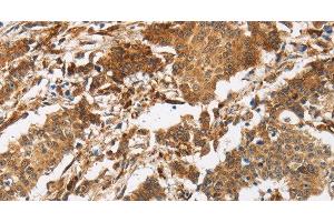 Immunohistochemistry of paraffin-embedded Human gasrtic cancer tissue using CALU Polyclonal Antibody at dilution 1:40 (CALU antibody)