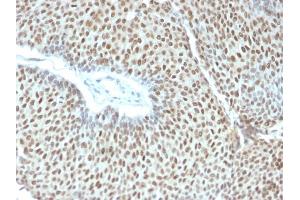 Formalin-fixed, paraffin-embedded human Cervical Tumor stained with Phospho c-Jun Mouse Monoclonal Antibody (C-J 4C4/1). (C-JUN antibody)