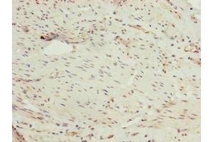 Immunohistochemistry of paraffin-embedded human bladder cancer using ABIN7162864 at dilution of 1:100