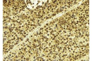 ABIN6275312 at 1/100 staining Human breast cancer tissue by IHC-P.