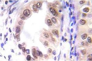 Immunohistochemistry (IHC) analyzes of p-STAT1 antibody in paraffin-embedded human lung carcinoma tissue. (STAT1 antibody  (pSer727))