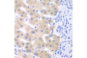 Immunohistochemistry of paraffin-embedded human liver cancer using CYP2C18 antibody. (CYP2C18 antibody)
