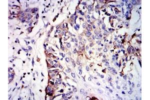 Immunohistochemical analysis of paraffin-embedded esophageal cancer tissues using GSTM1 mouse mAb with DAB staining. (GSTM1 antibody)