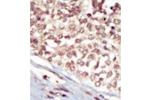 Formalin-fixed and paraffin-embedded human cancer tissue reacted with the primary antibody, which was peroxidase-conjugated to the secondary antibody, followed by AEC staining. (EPH Receptor A5 antibody  (C-Term))