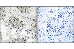 Immunohistochemistry analysis of paraffin-embedded human breast carcinoma tissue, using USP13 antibody. (USP13 antibody  (C-Term))