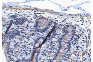 ABIN6267265 at 1/200 staining human colon carcinoma tissue sections by IHC-P. (EGFR antibody  (pTyr1197))