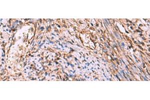 Immunohistochemistry of paraffin-embedded Human cervical cancer tissue using RHAG Polyclonal Antibody at dilution of 1:130(x200) (RHAG antibody)