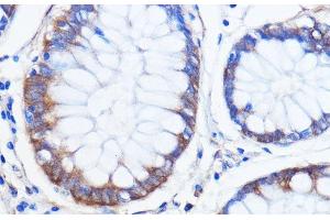 Immunohistochemistry of paraffin-embedded Human colon carcinoma using ATXN2 Polyclonal Antibody at dilution of 1:100 (40x lens). (Ataxin 2 antibody)