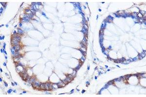 Immunohistochemistry of paraffin-embedded Human colon carcinoma using ATXN2 Polyclonal Antibody at dilution of 1:100 (40x lens).