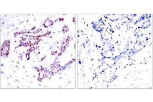 Immunohistochemistry analysis of paraffin-embedded human breast carcinoma, using STAT1 (Phospho-Tyr701) Antibody. (STAT1 antibody  (pTyr701))