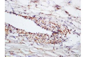 Formalin-fixed and paraffin embedded human lung carcinoma labeled with Anti-Phospho-eNOS (Ser1177)Polyclonal Antibody, Unconjugated  at 1:200 followed by conjugation to the secondary antibody and DAB staining (ENOS antibody  (pSer1177))