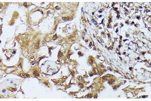 Immunohistochemistry of paraffin-embedded Human lung cancer using DAPK3 Polyclonal Antibody at dilution of 1:100 (40x lens). (DAPK3 antibody)