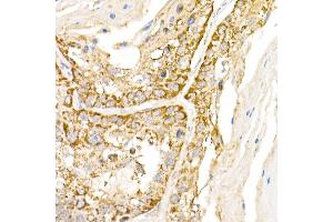 Immunohistochemistry of paraffin-embedded human lung cancer using B1 Rabbit pAb (ABIN6129916, ABIN6136962, ABIN6136963 and ABIN6222795) at dilution of 1:150 (40x lens). (AP3B1 antibody  (AA 895-1094))