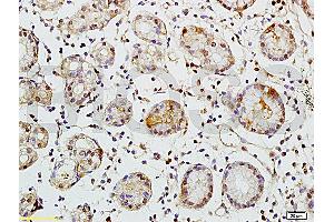 Formalin-fixed and paraffin embedded human colon carcinoma tissue labeled with Rabbit Anti-TEM1/CD248 Polyclonal Antibody (ABIN677573) at 1:200 followed by conjugation to the secondary antibody and DAB staining. (CD248 antibody  (AA 251-350))