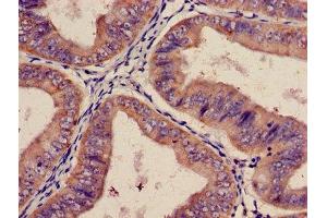 Immunohistochemistry of paraffin-embedded human endometrial cancer using ABIN7156430 at dilution of 1:100 (ITGA2 antibody  (AA 188-365))