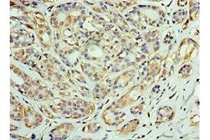 Immunohistochemistry of paraffin-embedded human breast cancer using ABIN7150549 at dilution of 1:100 (DNAJC2 antibody  (AA 1-140))