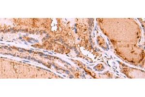 Immunohistochemistry of paraffin-embedded Human thyroid cancer tissue using HTRA4 Polyclonal Antibody at dilution of 1:35(x200) (HTRA4 antibody)