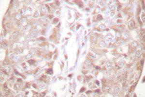 Immunohistochemical analysis of paraffin-embedded human breast cancer tissue using SENP1 polyclonal antibody . (SENP1 antibody)