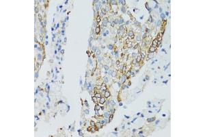 Immunohistochemistry of paraffin-embedded human lung cancer using SIRT2 antibody (ABIN5970103) at dilution of 1/100 (40x lens). (SIRT2 antibody)