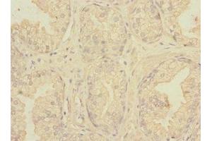 Immunohistochemistry of paraffin-embedded human prostate cancer using ABIN7161113 at dilution of 1:100 (nectin-3 antibody  (AA 310-549))