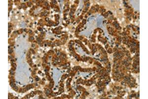 The image on the left is immunohistochemistry of paraffin-embedded Human thyroid cancer tissue using ABIN7190246(CHRDL2 Antibody) at dilution 1/20, on the right is treated with synthetic peptide. (CHRDL2 antibody)
