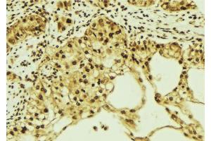 ABIN6276850 at 1/100 staining Human breast cancer tissue by IHC-P. (KPNA1 antibody  (N-Term))