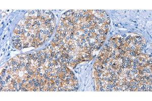Immunohistochemistry of paraffin-embedded Human prostate cancer using CD239 Polyclonal Antibody at dilution of 1:40