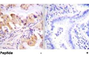 Immunohistochemical analysis of paraffin-embedded human lung carcinoma tissue using PTGES3 polyclonal antibody . (PTGES3 antibody  (Ser113))
