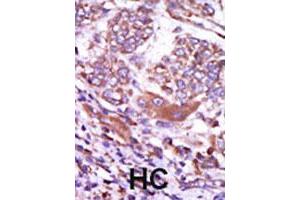 Formalin-fixed and paraffin-embedded human hepatocellular carcinoma tissue reacted with CAMK2D polyclonal antibody  , which was peroxidase-conjugated to the secondary antibody, followed by AEC staining. (CAMK2D antibody  (C-Term))