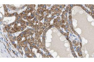 ABIN6269117 at 1/100 staining Human liver cancer tissue by IHC-P. (IGF1R antibody  (C-Term))