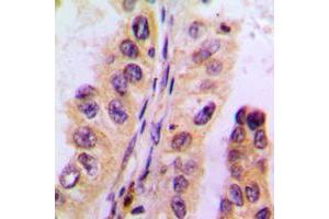 Immunohistochemical analysis of Cytochrome P450 3A4/5 staining in human liver cancer formalin fixed paraffin embedded tissue section. (Cytochrome P450 3A4, 3A5 (Center) antibody)