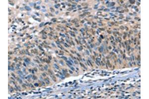 The image on the left is immunohistochemistry of paraffin-embedded Human cervical cancer tissue using ABIN7190052(CAMTA1 Antibody) at dilution 1/15, on the right is treated with synthetic peptide. (CAMTA1 antibody)