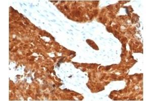 Formalin-fixed, paraffin-embedded human ovarian carcinoma stained with P16INK4a Recombinant Rabbit Monoclonal Antibody (CDKN2A/7081R). (Recombinant CDKN2A antibody)