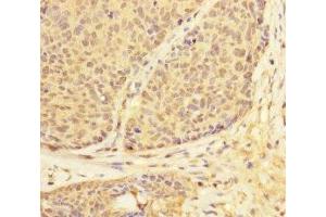 Immunohistochemistry of paraffin-embedded human ovarian cancer using ABIN7174303 at dilution of 1:100 (USP28 antibody  (AA 430-580))