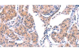 Immunohistochemistry of paraffin-embedded Human lung cancer tissue using VWF Polyclonal Antibody at dilution 1:50 (VWF antibody)