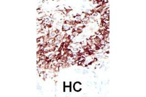 Formalin-fixed and paraffin-embedded human hepatocellular carcinoma tissue reacted with the HDAC11 polyclonal antibody  , which was peroxidase-conjugated to the secondary antibody, followed by DAB staining. (HDAC11 antibody  (N-Term))