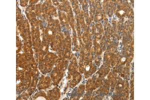 Immunohistochemistry of Human thyroid cancer using PTCH1 Polyclonal Antibody at dilution of 1:50 (Patched 1 antibody)