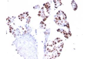 Formalin-fixed, paraffin-embedded human Breast Carcinoma stained with RNA Polymerase II / Poll II Mouse Monoclonal Antibody (CTD4H8).