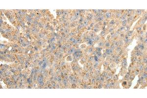 Immunohistochemistry of paraffin-embedded Human ovarian cancer tissue using SYT11 Polyclonal Antibody at dilution 1:30