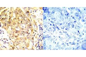 Immunohistochemical analysis of paraffin- embedded human breast carcinoma tissue using P53 (Ab-20) antibody (E022030). (p53 antibody)