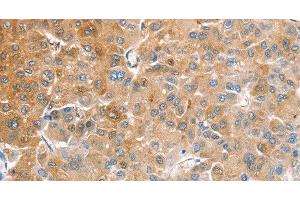 Immunohistochemistry of paraffin-embedded Human liver cancer tissue using CDR2 Polyclonal Antibody at dilution 1:60