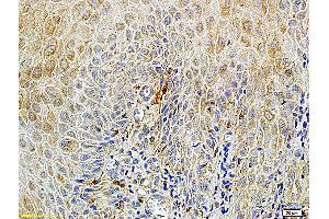 Formalin-fixed and paraffin embedded human endometrium carcinoma labeled with Rabbit Anti-Matriptase Polyclonal Antibody (ABIN669726), Unconjugated at 1:100 followed by conjugation to the secondary antibody and DAB staining.