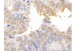 Detection of GAL3 in Human Colorectal cancer Tissue using Polyclonal Antibody to Galectin 3 (GAL3) (Galectin 3 antibody  (AA 1-250))