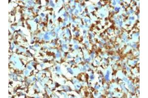 Immunohistochemical staining (Formalin-fixed paraffin-embedded sections) of human histiocytoma with F13A1 monoclonal antibody, clone F13A1/1448 .