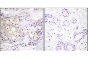 Immunohistochemistry analysis of paraffin-embedded human breast carcinoma, using PKC alpha (Phospho-Thr638) Antibody.