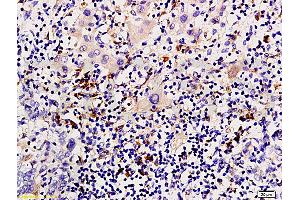 Formalin-fixed and paraffin embedded human liver carcinoma tissue labeled with Anti-P-CK/Cytokeratin AE1+AE3 Polyclonal Antibody, Unconjugated (ABIN733343) at 1:200 followed by conjugation to the secondary antibody and DAB staining (Cytokeratin 1 antibody  (AA 141-240))