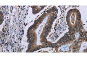 Immunohistochemistry of paraffin-embedded Human ovarian cancer tissue using ITGAE Polyclonal Antibody at dilution of 1:50 (CD103 antibody)