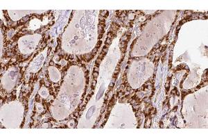 ABIN6266447 at 1/100 staining Human thyroid cancer tissue by IHC-P. (RYR2 antibody  (Internal Region))